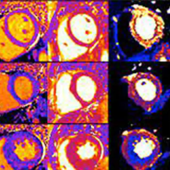 fabry disease quantitative test
